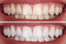 Teeth whitening Navi Mumbai